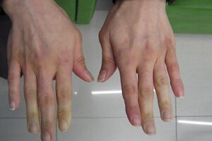  نکاتی مهم درباره سرمازدگی