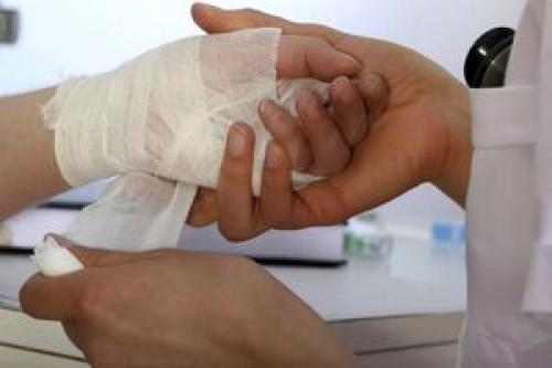 استفاده از آب سرد؛ بهترین راه برای مقابله با سوختگی
