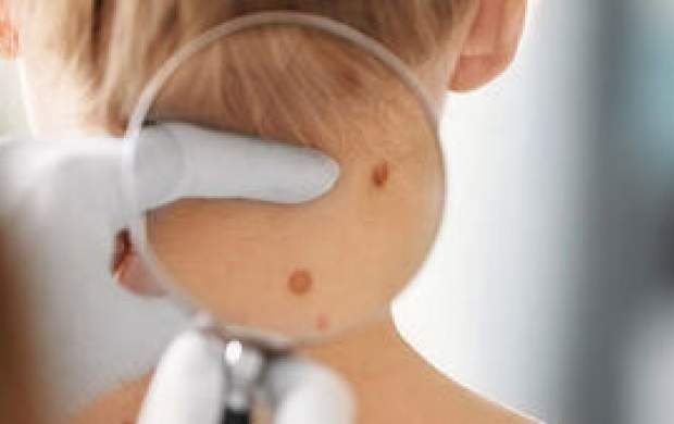 کشف راز درمان سرطان پوست