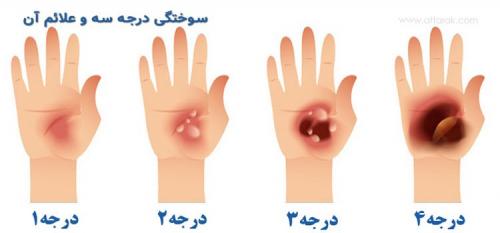  با انواع سوختگی آشنا شوید