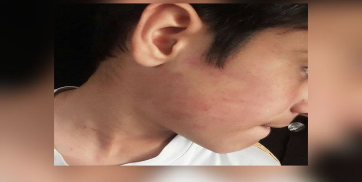 ماجرای تنبیه بدنی شدید یک دانش‌آموز