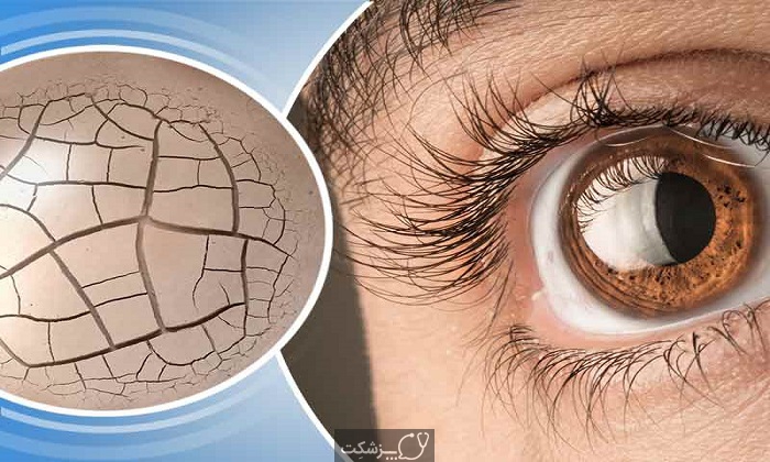  با خشکی چشم در فصل بهار چه کنیم؟
