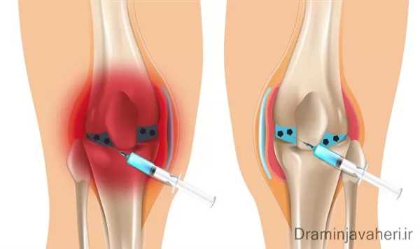  دلایل آب آوردن زانو و راه‌های پیشگیری آن