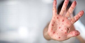  شباهت آبله میمون به زونا و آبله مرغان