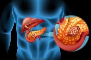  راه های پیشگیری از سرطان را بشناسیم