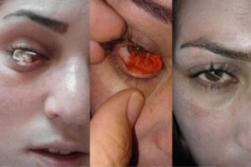 پرونده مختومه چشمی که نخ تولید می‌کرد