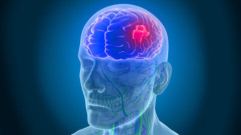  اینفوگرافیک/ آشنایی با علائم سکته مغزی