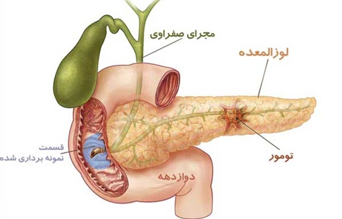 اینفوگرافیک/ دانستنی‌هایی درباره سرطان لوزالمعده