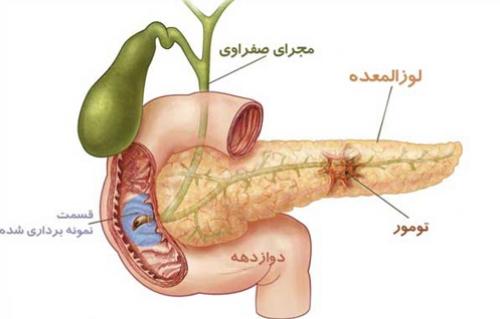 اینفوگرافیک/ دانستنی‌هایی درباره سرطان لوزالمعده