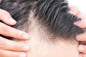  چه چیزی باعث ریزش مو در مردان می‌شود؟