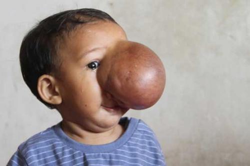 رشد باور نکردنی تومور روی صورت دختربچه
