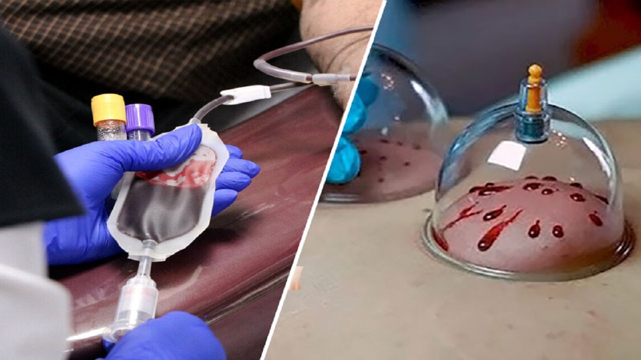  آیا خروج خون کثیف از بدن با حجامت، صحت دارد؟