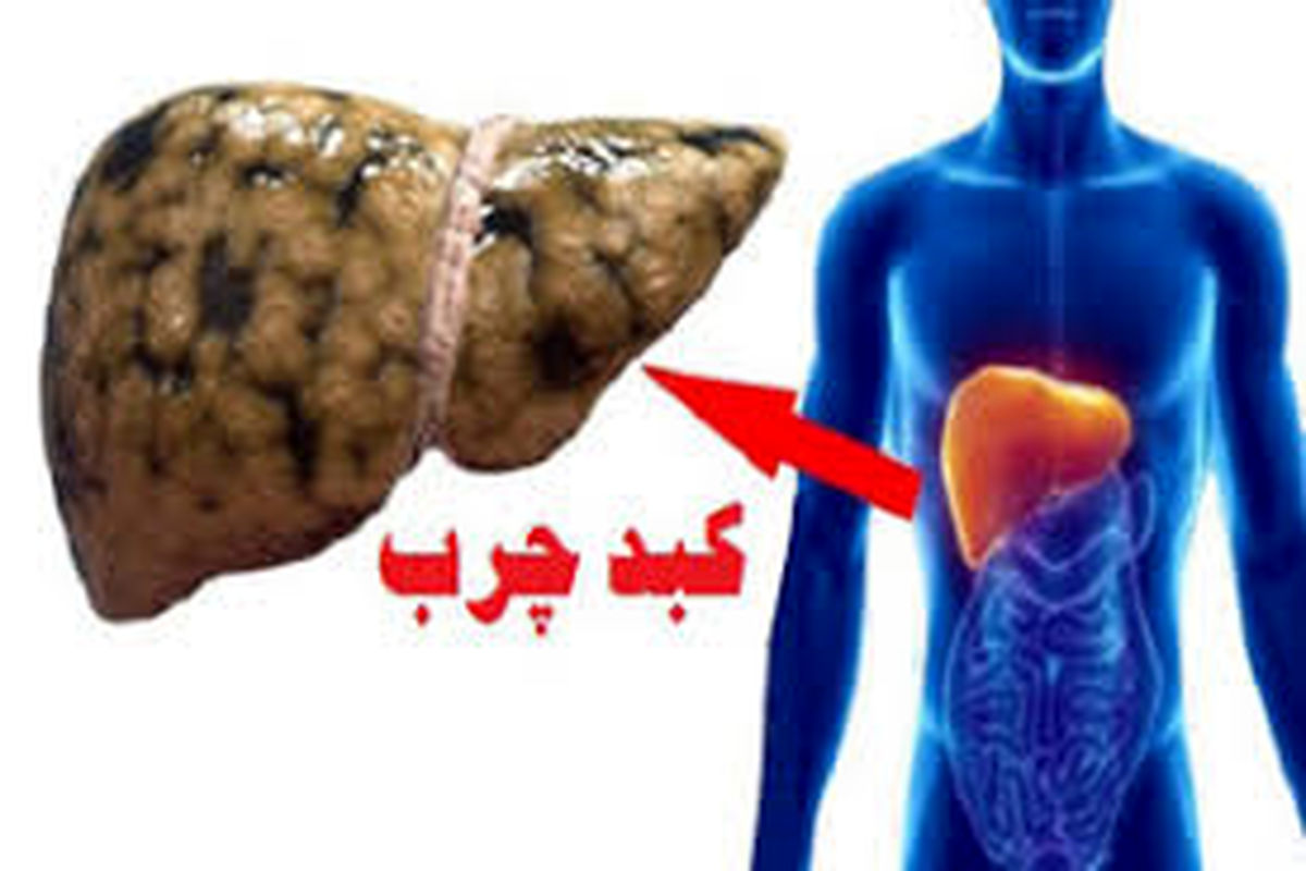  آشنایی با بیماری کبد چرب و علایم آن 