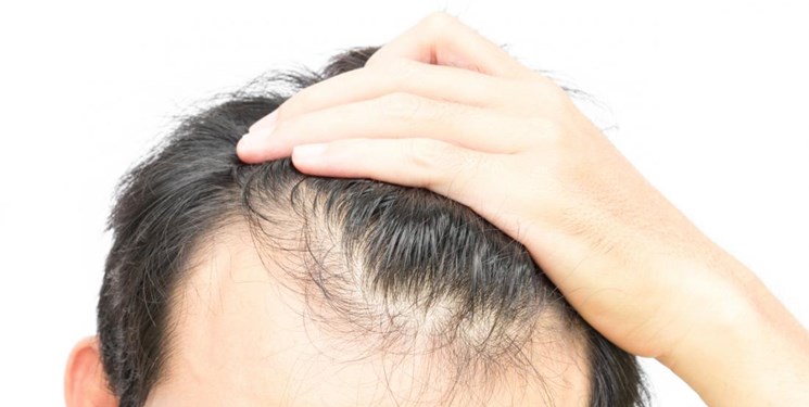  چطور بفهمیم ریزش مو داریم؟
