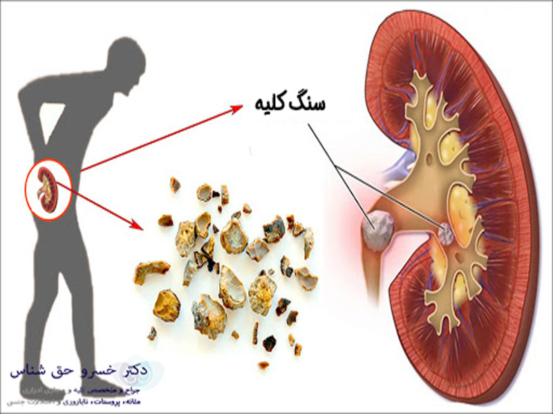  علت اصلی ایجاد سنگ کلیه