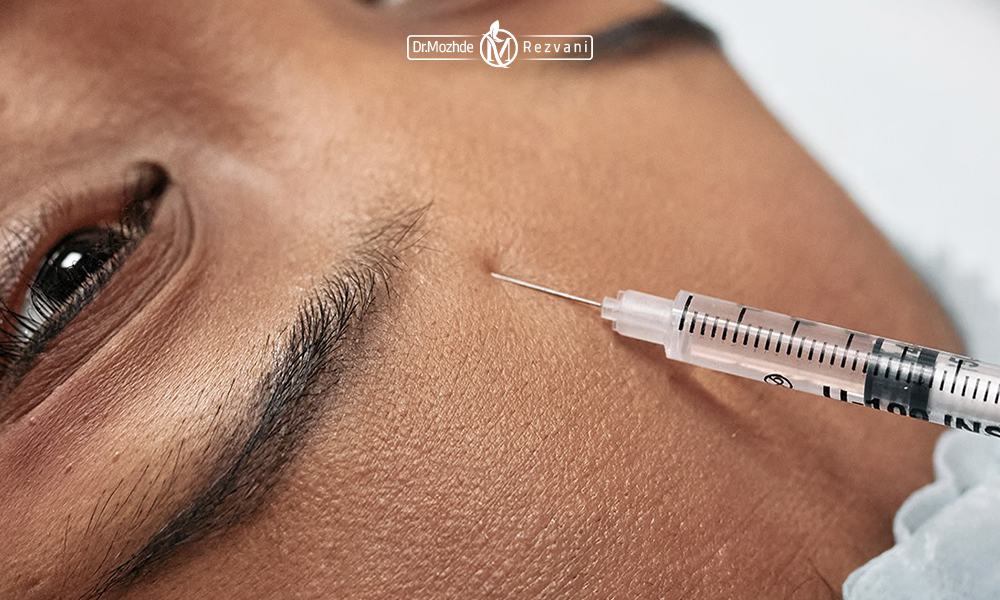 بوتاکس در کدام ناحیه از صورت تزریق می شود؟