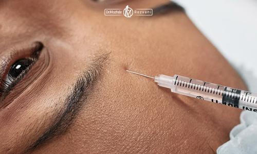 بوتاکس در کدام ناحیه از صورت تزریق می شود؟
