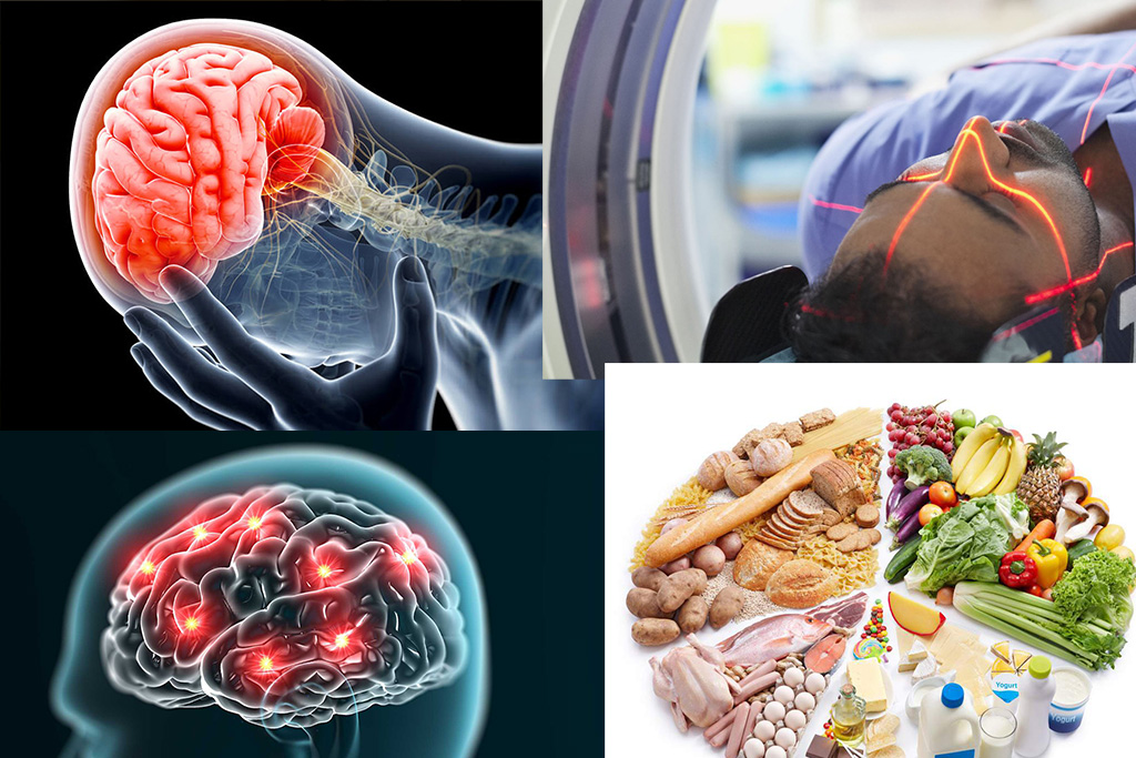 عوارض و تاثیر چاقی روی مغز 