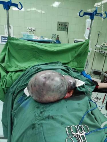 خروج توده شکمی 20کیلویی 