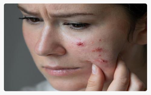 جوش‌های صورت چگونه زندگی را تهدید می‌کنند؟