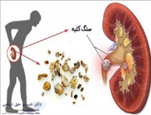اینفوگرافیک/عاداتی که باعث سنگ کلیه می شود