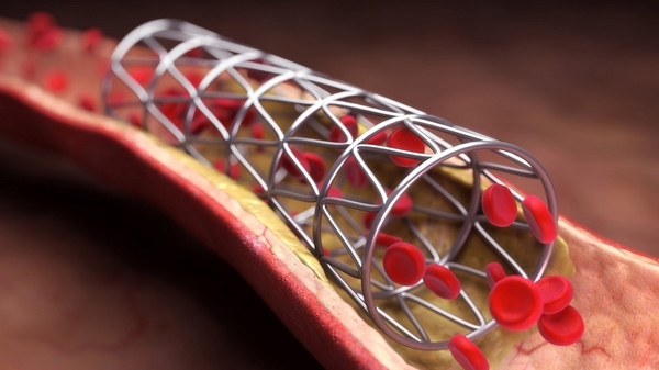 باز کردن رگ‌های بسته قلب با بالون ایرانی