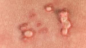 هر آنچه باید درباره بیماری HPV بدانید