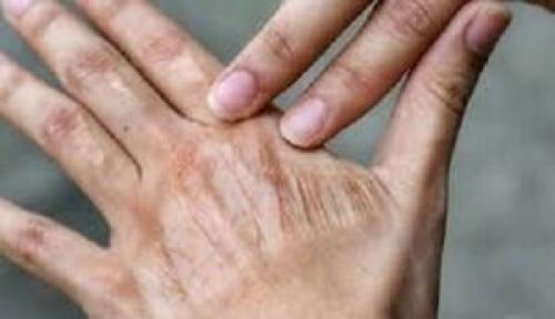 جلوگیری از خشکی پوست در پاییز 