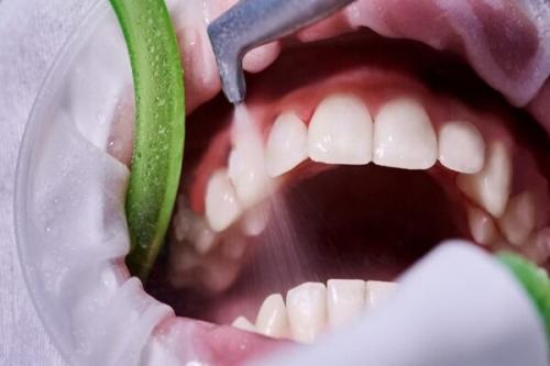 پیشگیری از بیماری‌های لثه‌ای