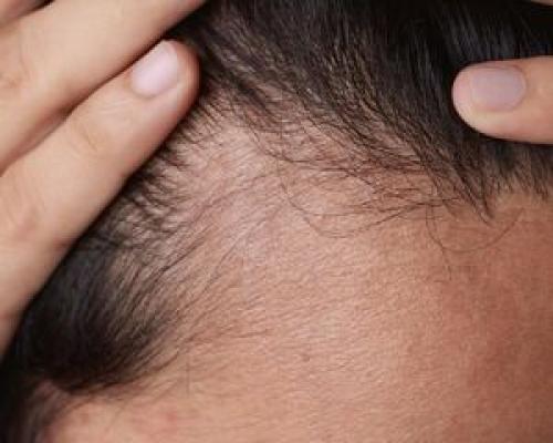  عادات ساده برای جلوگیری از ریزش مو
