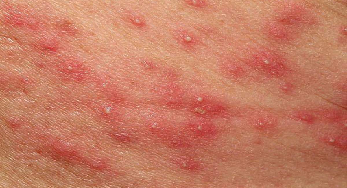 درمان خانگی جوش چرکی چیست ؟ 