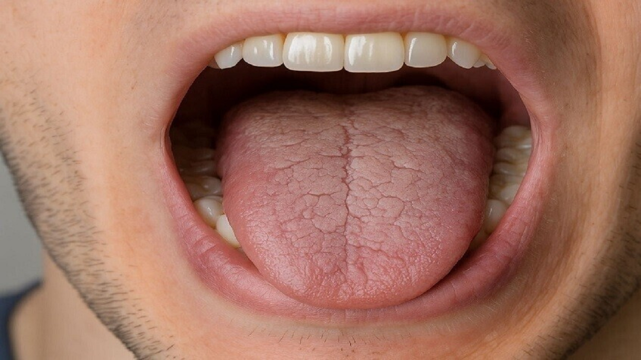 علل سندرم خشکی دهان 