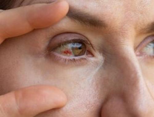 دلایل پارگی رگ خونی درچشم