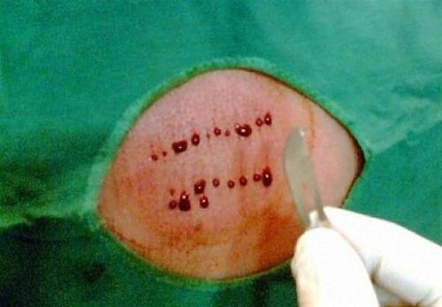 هشدار جدی درباره حجامت های زیر زمینی 
