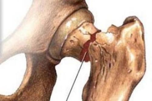 چگونه از پوکی استخوان جلوگیری نماییم